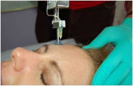 mesotherapie voor gezicht
