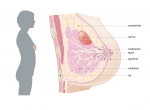 trompert-borstkanker-doorsnede-borst