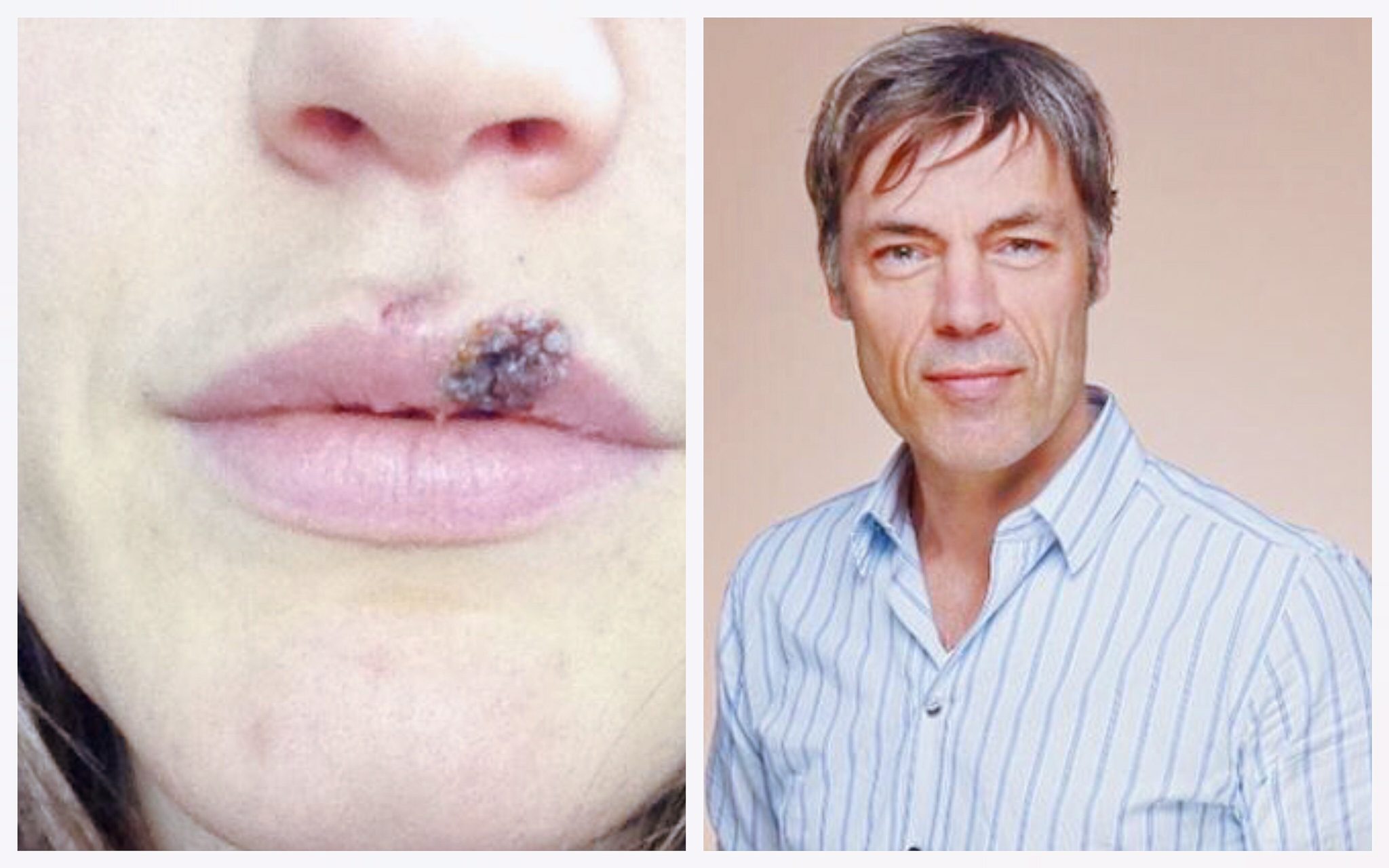 ua wond in lip